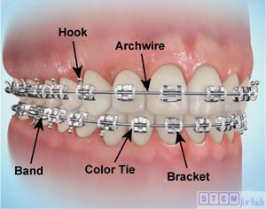 Braces-and-Smiles-Orthodontic-Emergency-1
